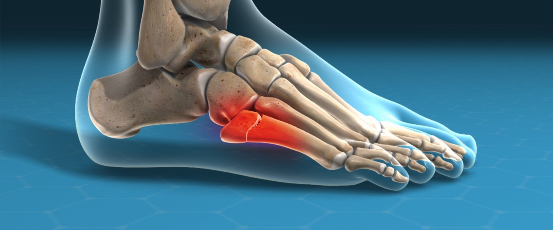 The Truth About Foot Pain: Tendonitis vs Fracture