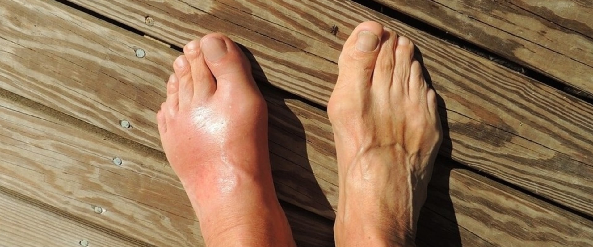 Expert Insights: Managing Midfoot Arthritis for Improved Mobility