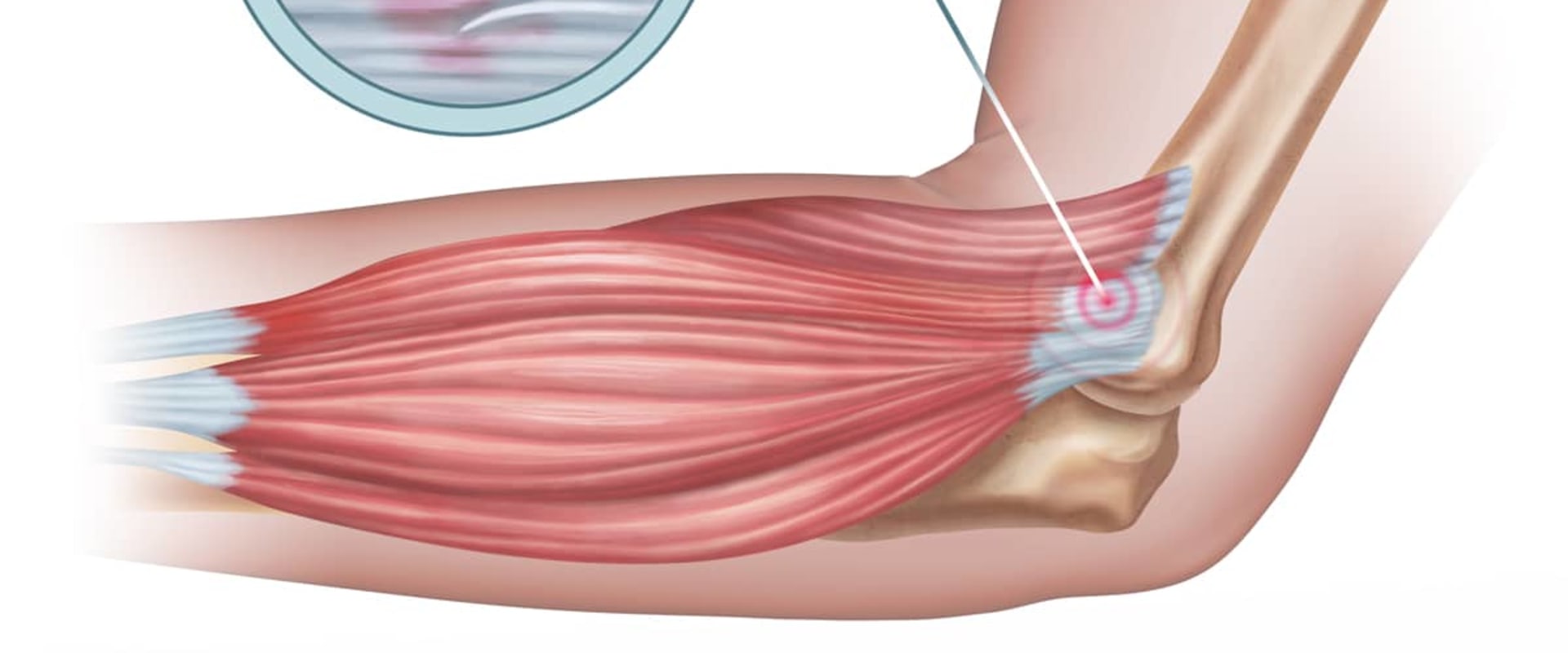 Tendinitis: Understanding the Causes, Symptoms, and Treatment