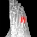 The Expert's Guide to Diagnosing and Treating Stress Fractures in the Foot