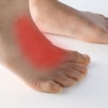 The Road to Recovery: Understanding and Treating Tendonitis on Top of the Foot
