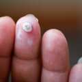 Wart Healing Timeline Revealed: Stages After Freezing & What to Expect