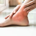 Expert Tips for Treating Inflammation on the Top of Your Foot