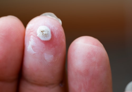 Wart Healing Timeline Revealed: Stages After Freezing & What to Expect